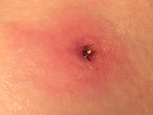 Tick that gave Nancy Lankow Lyme disease