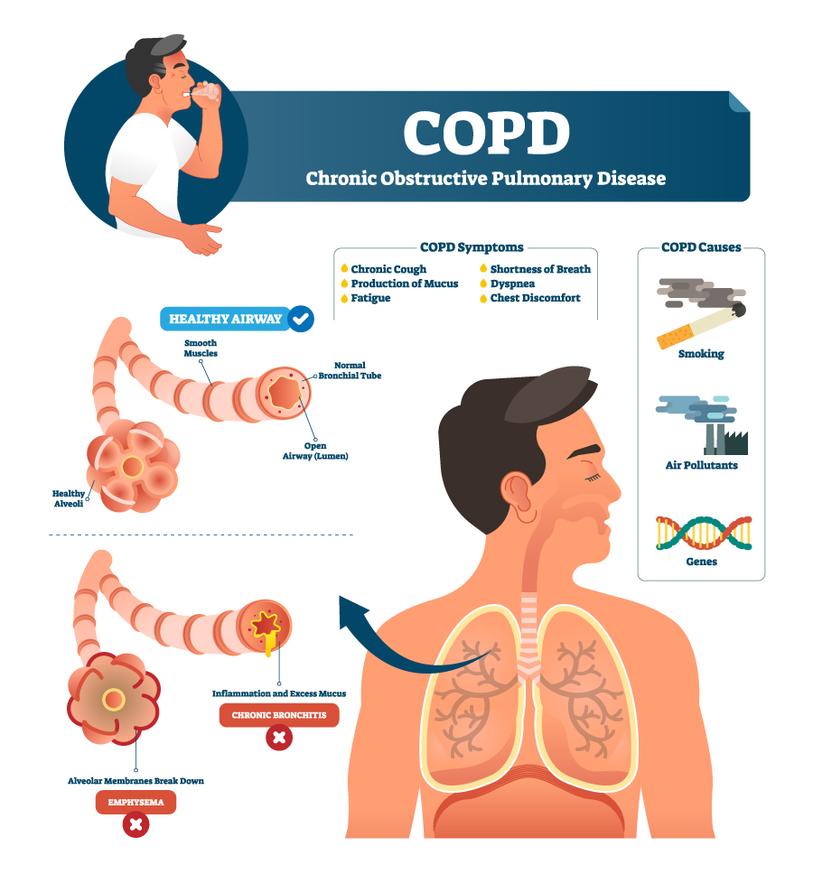 COPD Medical Diagnosis: Spirometry, X-Ray, as well as 6 More ...