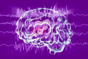  Brain and encephalography in epilepsy patient during seizure attack