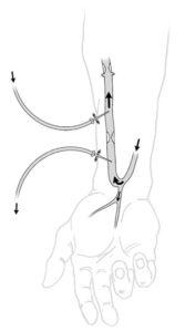 drawing of a fistula 